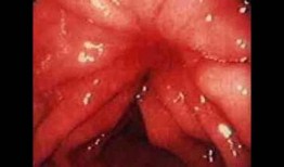 胃炎吃瓜和包米胃口疼,吃瓜与包米引发胃口疼痛