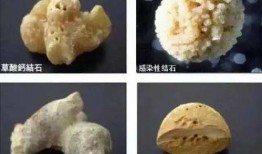 肾结石可以吃毛瓜